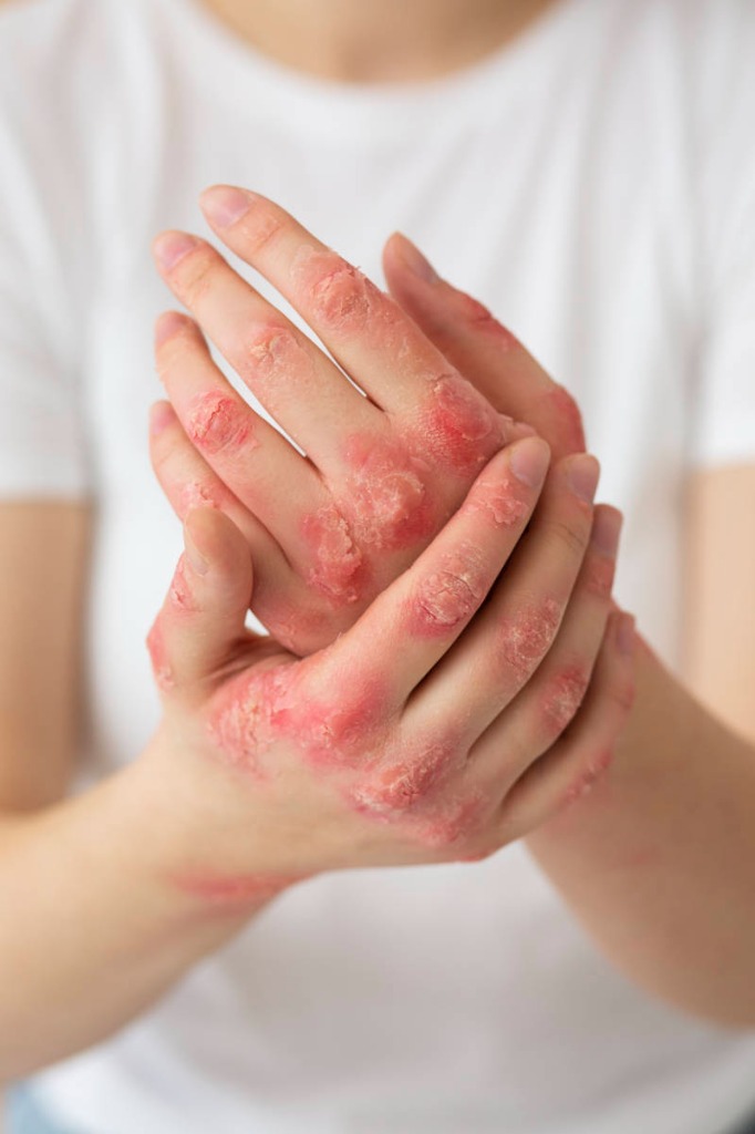 Eczema Care